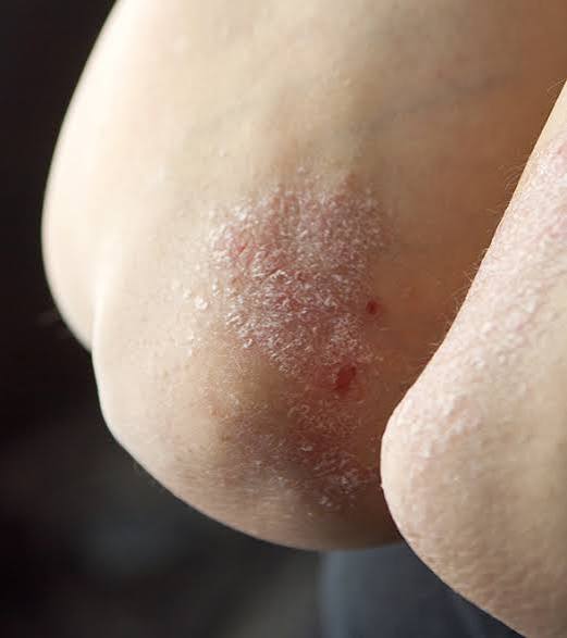 Psoriasis - My Store